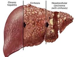 Cirrhosis of the liver case study